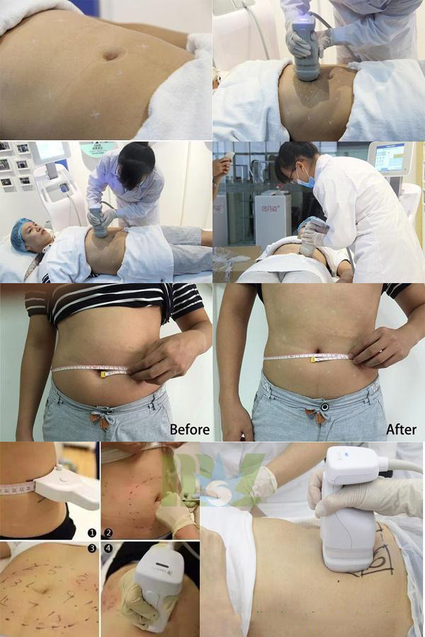 hifu body slimming machine MSLHF03