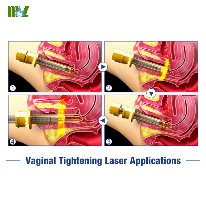 Advanced Laser Vaginal Tightening Machine MSLCF02