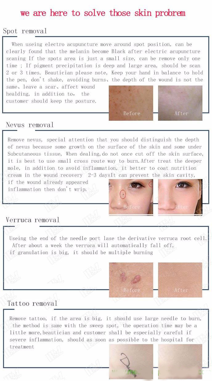 Beauty Mole Removal